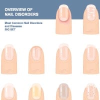 Varied Colours Of The Nail: Know What They Indicate About Your Health?