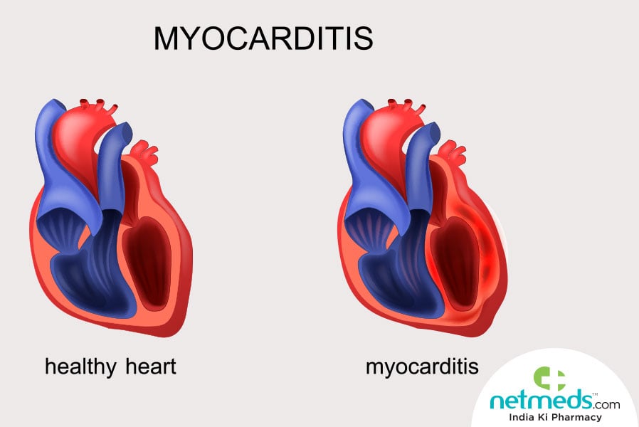 myocarditis