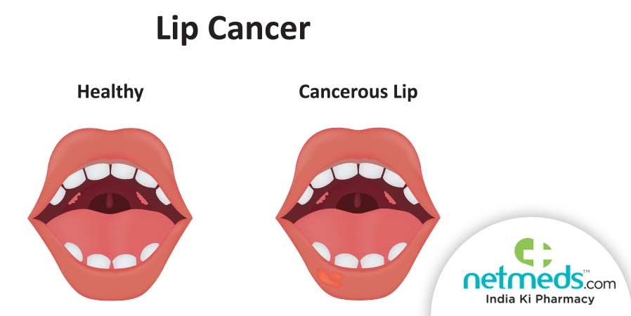 Lip Cancer