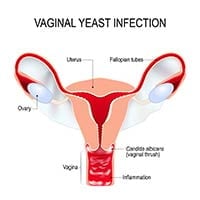 Vaginal Yeast Infection: Causes, Symptoms And Treatment