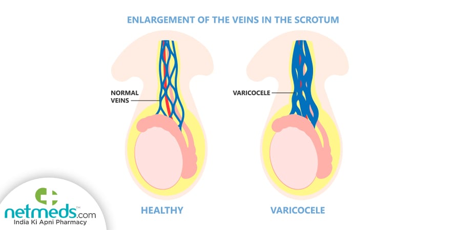 Varicocele