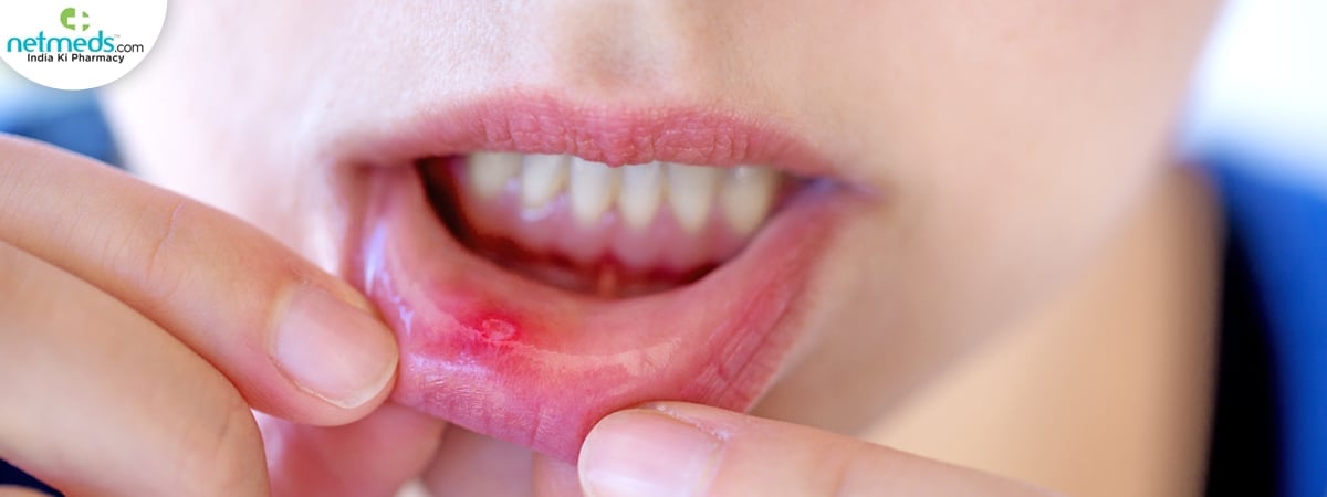 canker sores