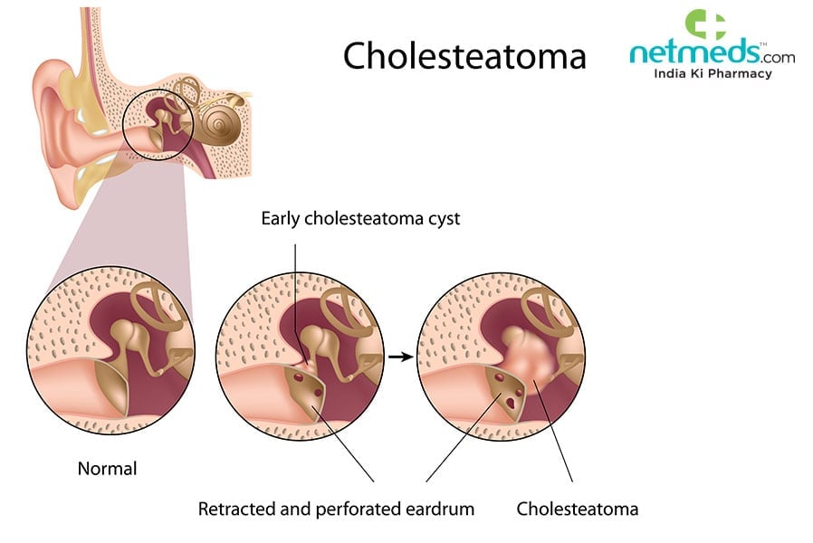 cholesteatoma