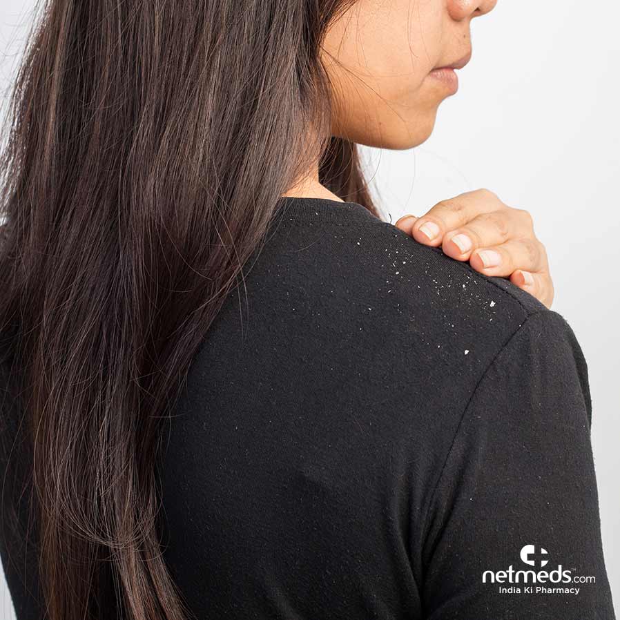 Dandruff on a woman's dress