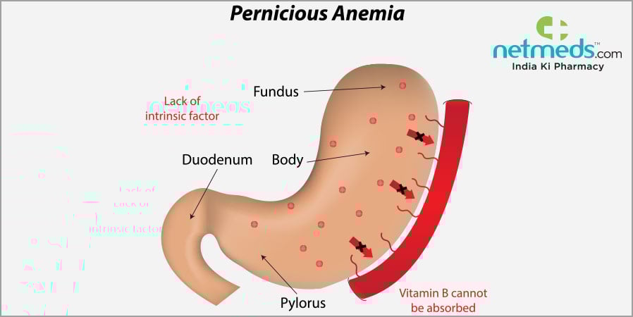 Pernicious Anaemia Causes