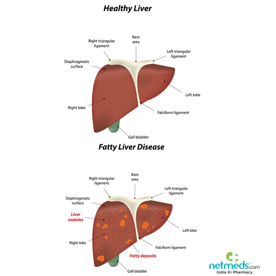Fatty liver and its impact on liver health