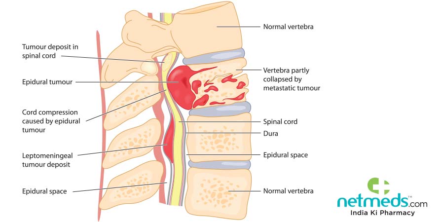 Spinal cord tumour