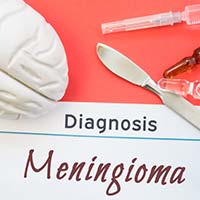 Meningioma: Causes, Symptoms And Treatment
