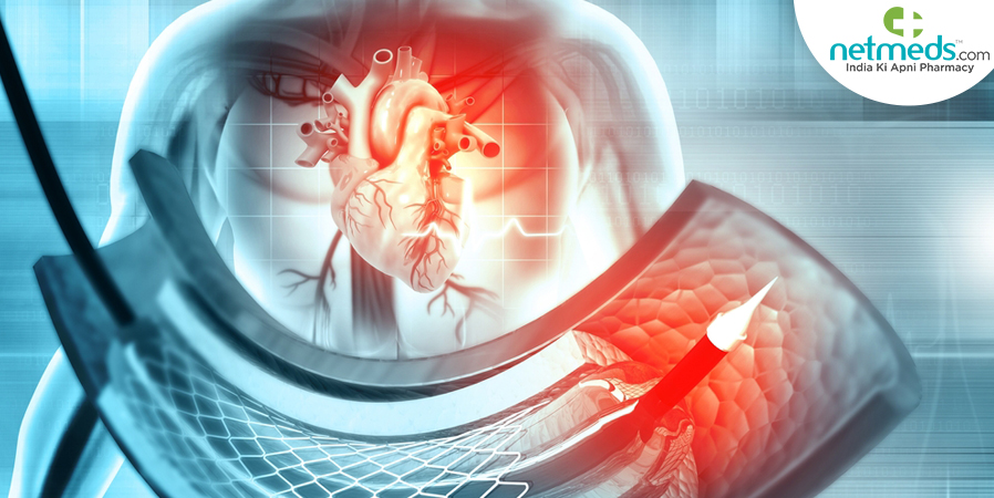 Catheter angiography