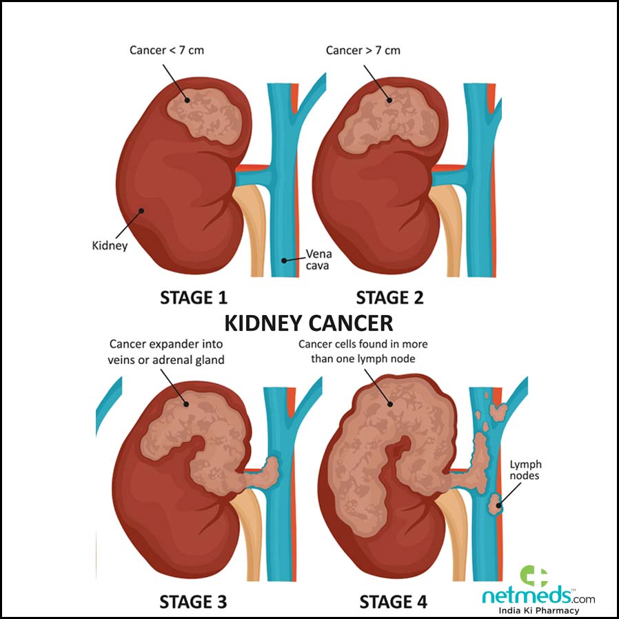 kidney cancer