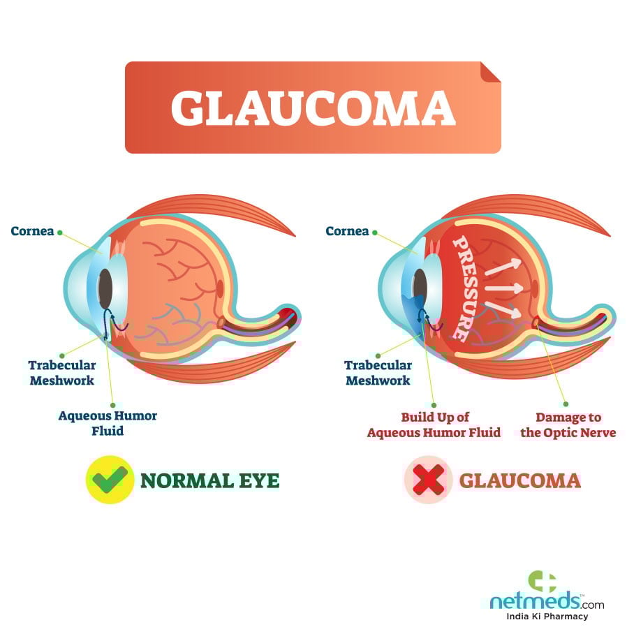 Glaucoma