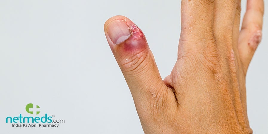 Herpetic Whitlow in thumb
