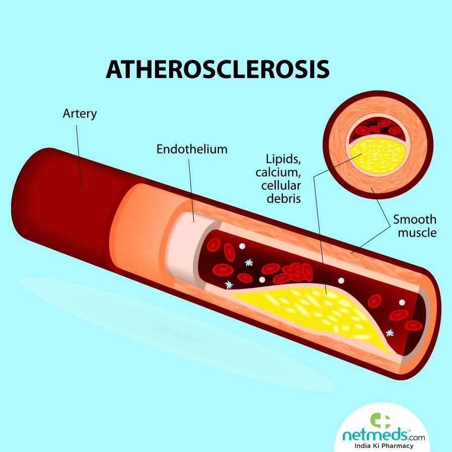 Atherosclerosis