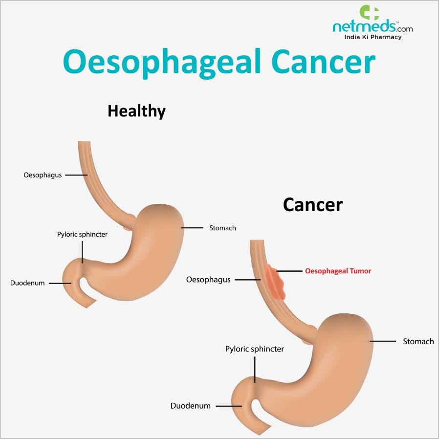 oesophageal cancer