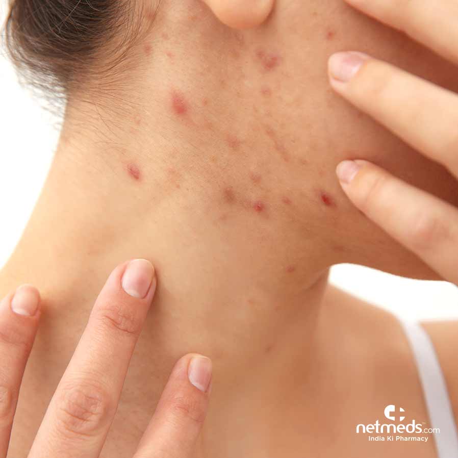 Girl with acne