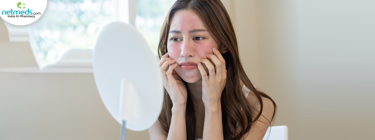 eczema