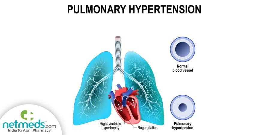 Pulmonary Hypertension