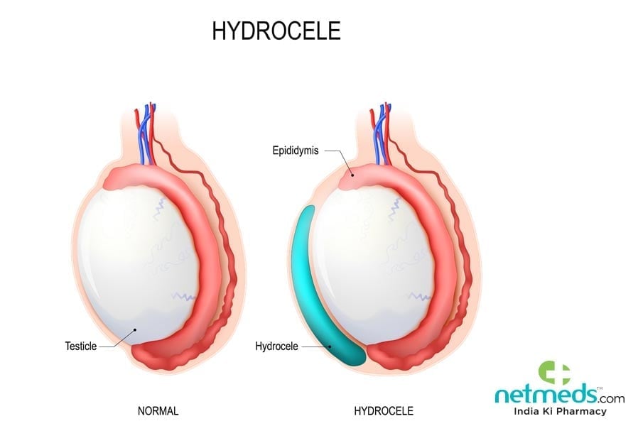 hydrocele