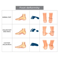 Struggling With Flat Feet? Superb Yoga Poses To Manage Fallen Arches At Home