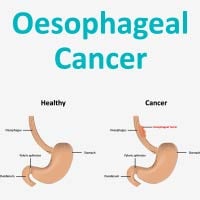 Oesophageal Cancer: Causes, Symptoms and Treatment