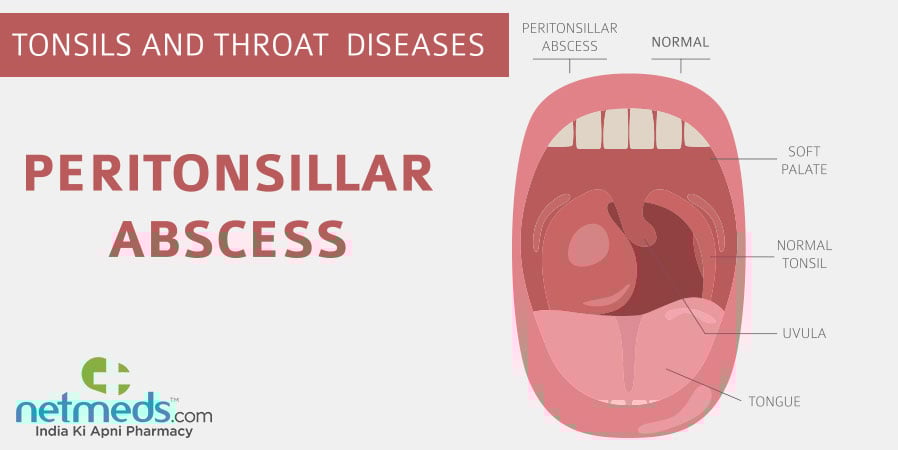 Peritonsillar Abscess