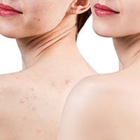 5 Simple Bacne Treatments | DIY Tea Tree Oil Mask For Back Acne