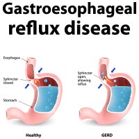 GERD: Symptoms, Causes, Stages, And Treatment