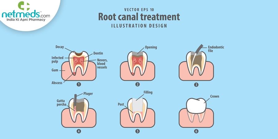 Root canal treatment