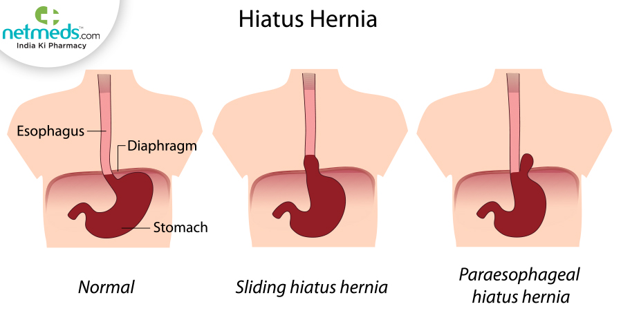 hiatal hernia