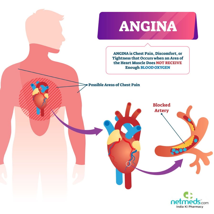 angina