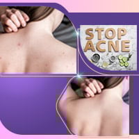 Bacne: 5 Spectacular Home Remedies To Get Rid Of Back Acne Naturally – Infographic