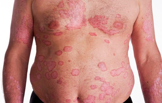 psoriasis-symptoms-and-signs
