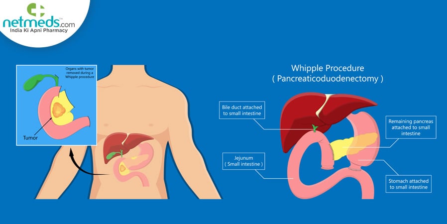 Ampullary Cancer