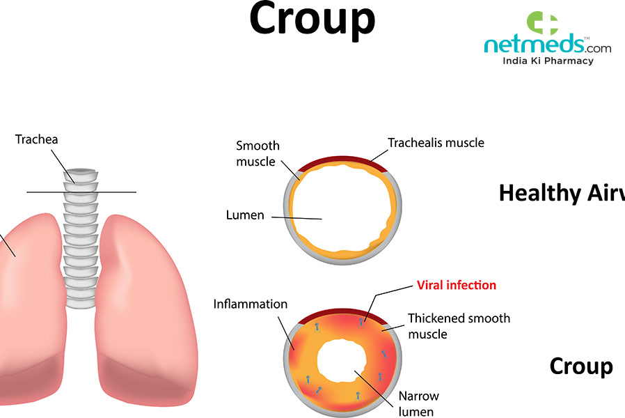 croup symptoms