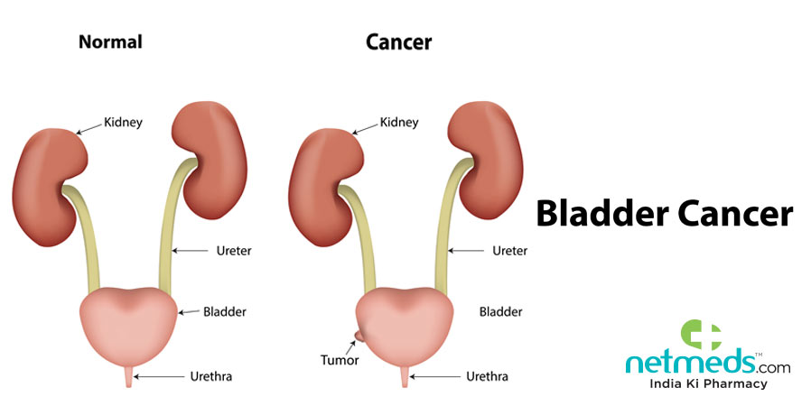 Bladder cancer illustration