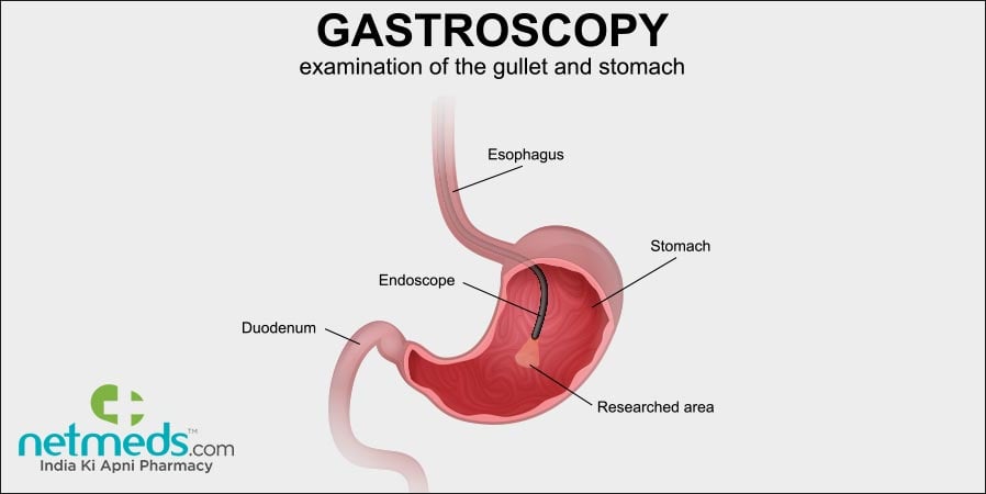 Gastroscopy - Examination of the gullet and stomach