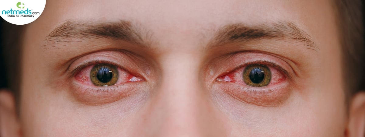 Eye infection