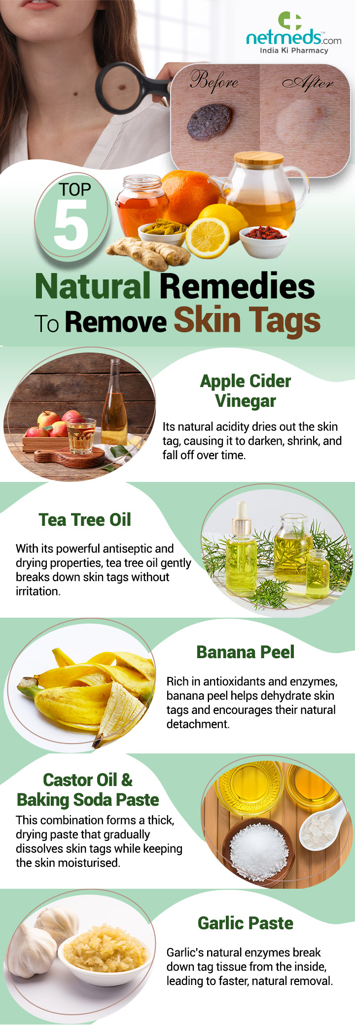 home remedies for skin tags