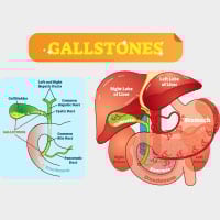 Gallstones: Symptoms, Causes And Treatment