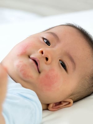 Prickly Heat in Newborns: Causes, Symptoms, and Effective Home Remedies