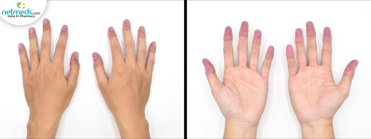 Skin changes