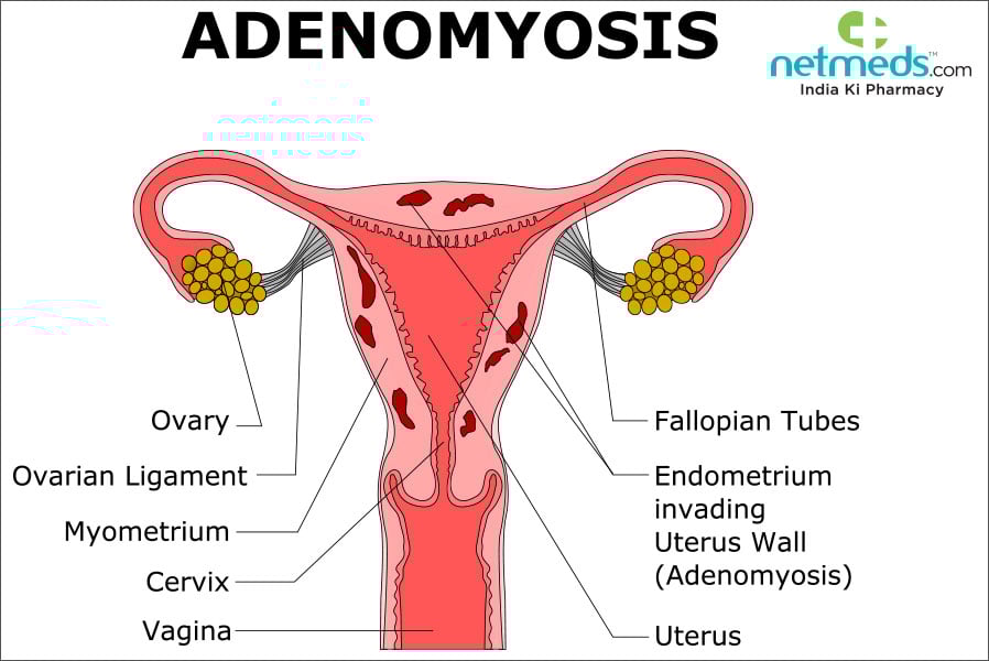 adenomyosis