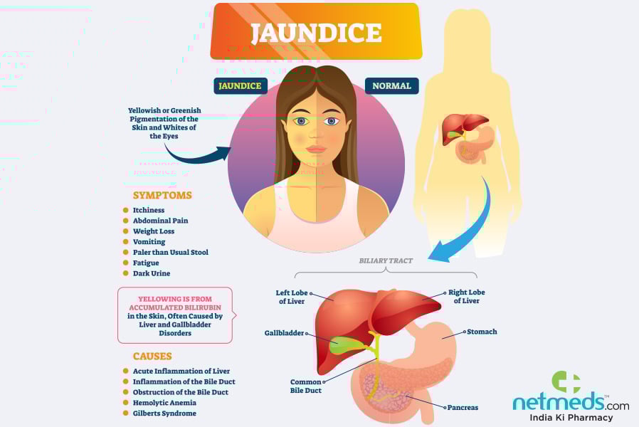 jaundice in adults