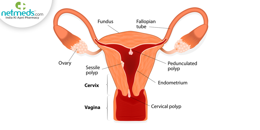 Cervical Polyps