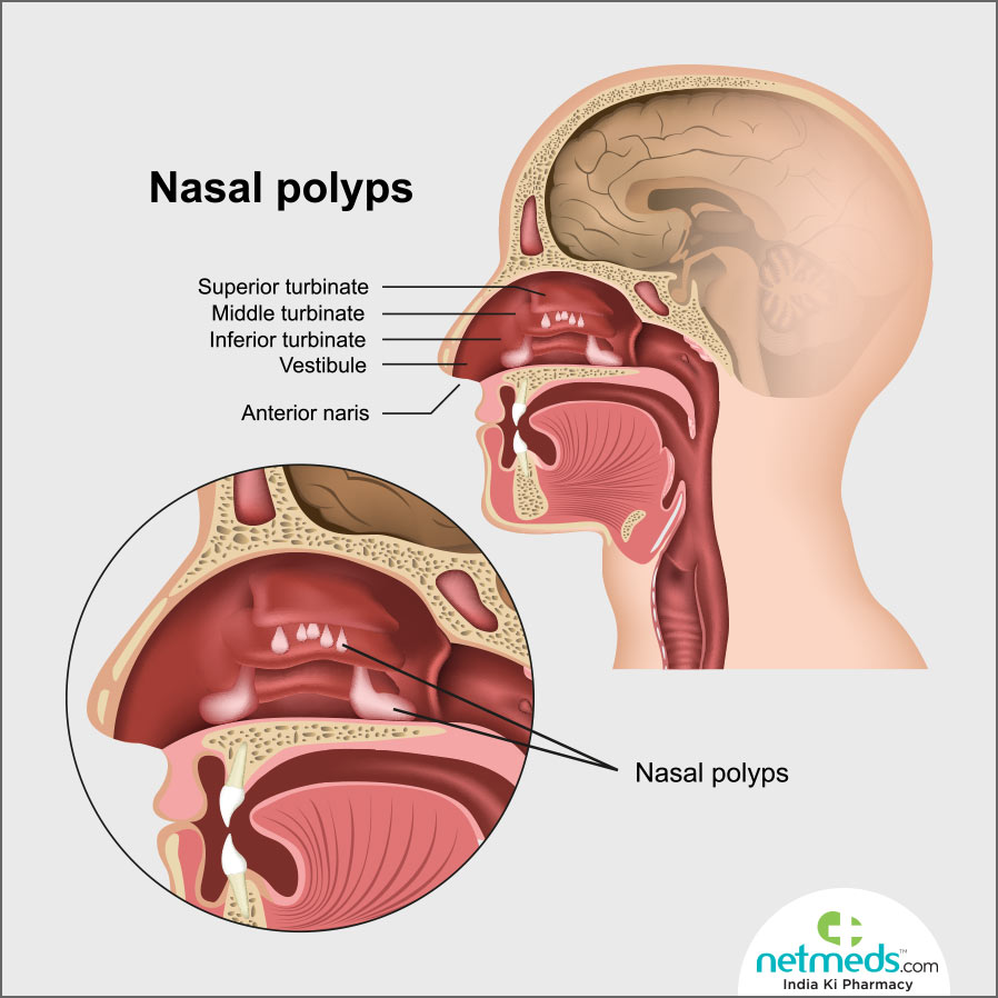 nasal polyps