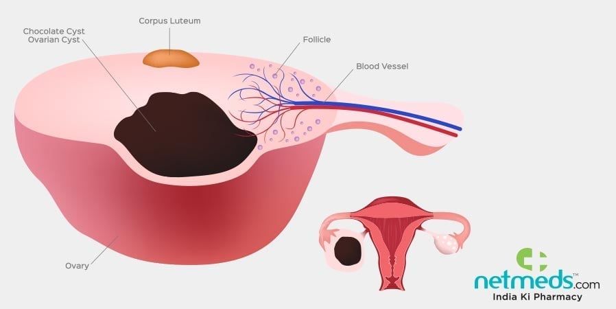 chocolate cysts