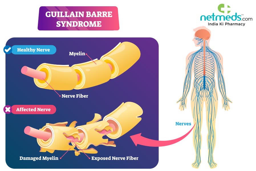 guillian barre syndrome