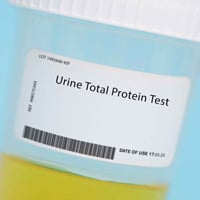 24-Hour Urine Protein Test: What Is It, Purpose, Benefits And Results