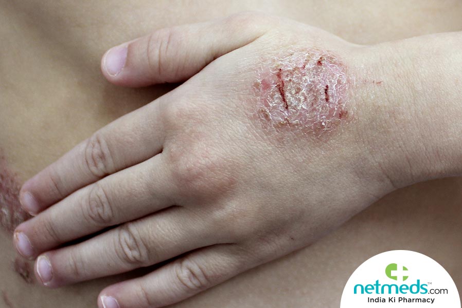 discoid eczema