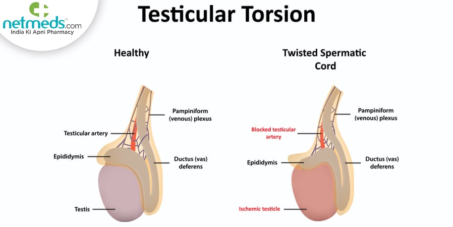 Testicular Torsion